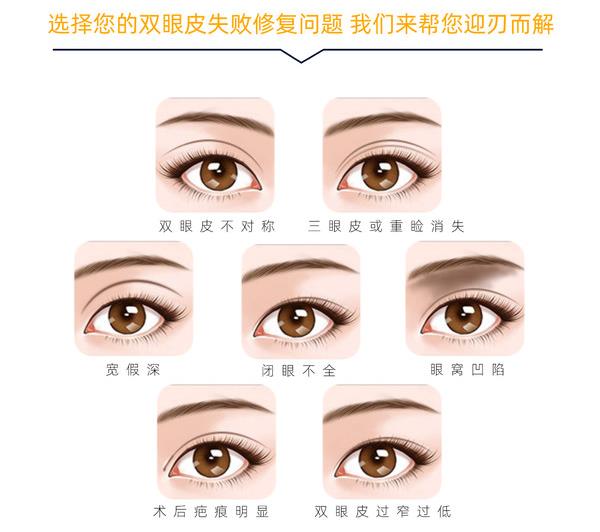 吳焱秋醫(yī)生做雙眼皮修復怎樣？專業(yè)技術與豐富經(jīng)驗加持打造自然靈動美眼效果