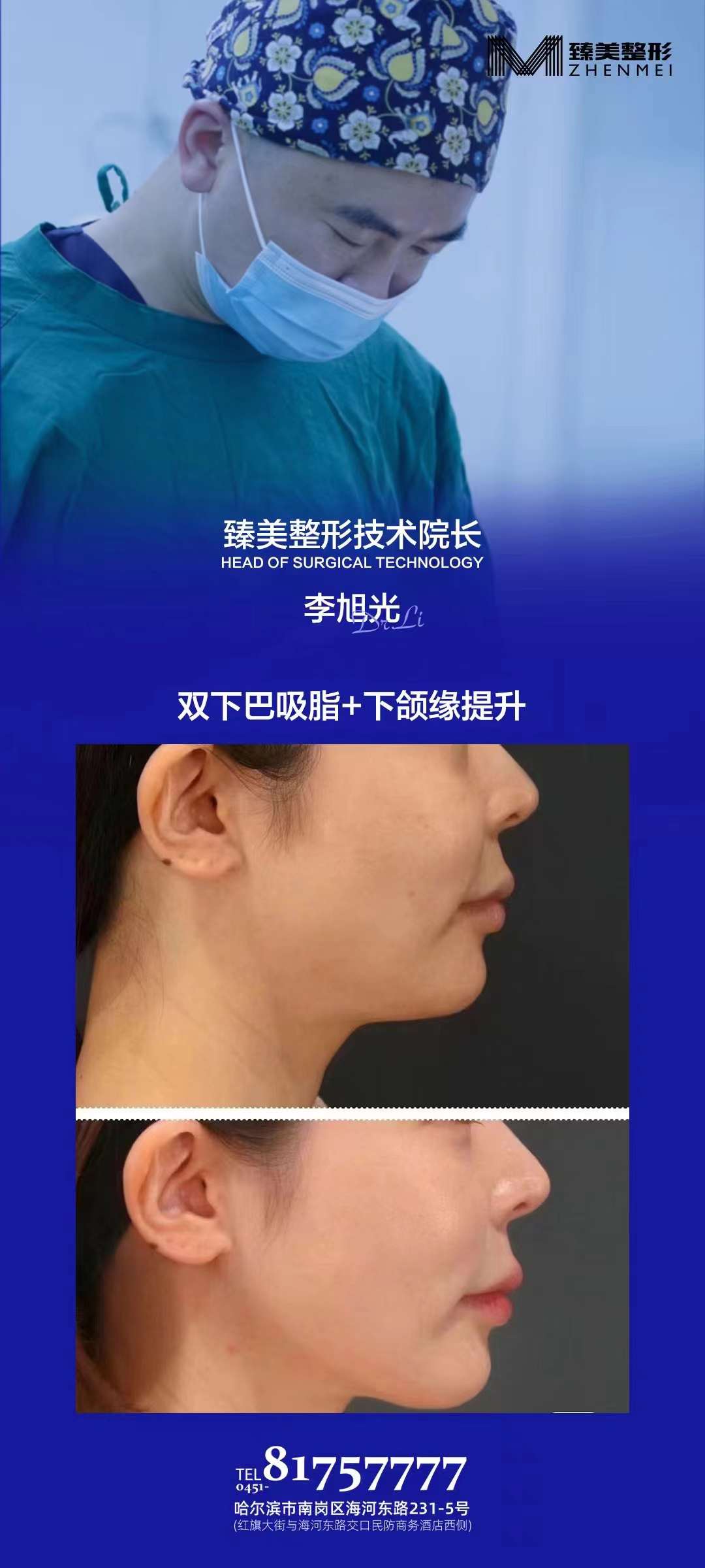 哈爾濱做飛秒近視手術(shù)好的醫(yī)院及價格：愛爾、華廈、普瑞各有套餐，最低6800元起！ 