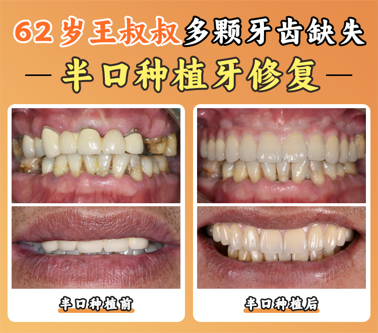 二、蘭州海濤口腔的種植技術(shù)優(yōu)勢