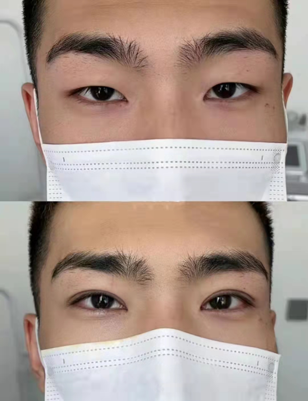 為什么說吳焱秋修復(fù)雙眼皮是性價比之選？