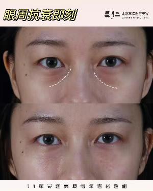 北京大學(xué)第三醫(yī)院：特色鮮明，個(gè)性化治療白內(nèi)障