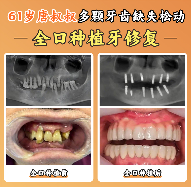 青浦種牙哪家醫(yī)院好？排名前10醫(yī)院揭秘，維佳康、拜博、美樂等任你選！ 