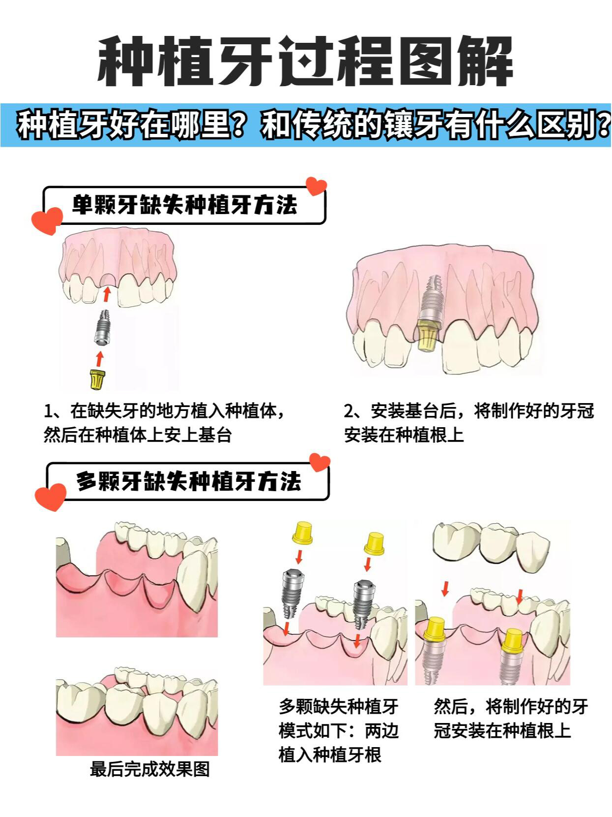 一、青浦種牙醫(yī)院選擇指南