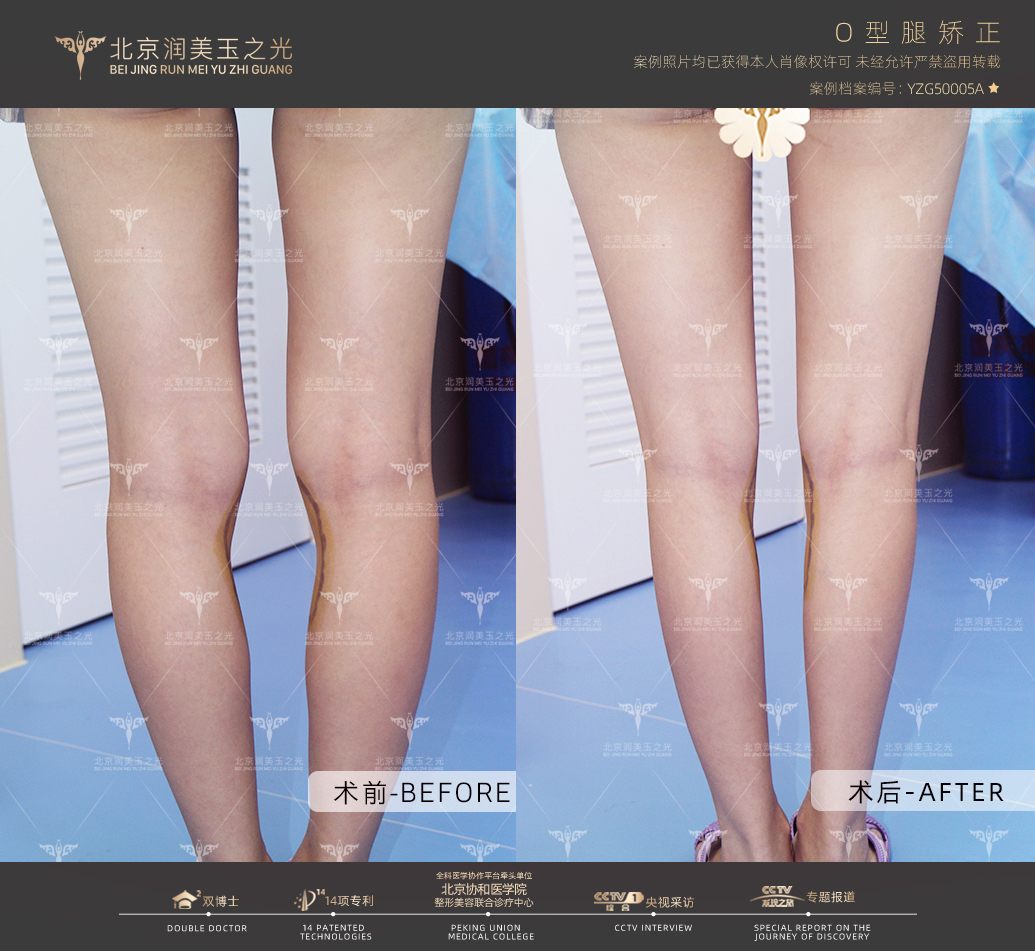 北京大學(xué)人民醫(yī)院：技術(shù)成熟，多類型白內(nèi)障治療優(yōu)選