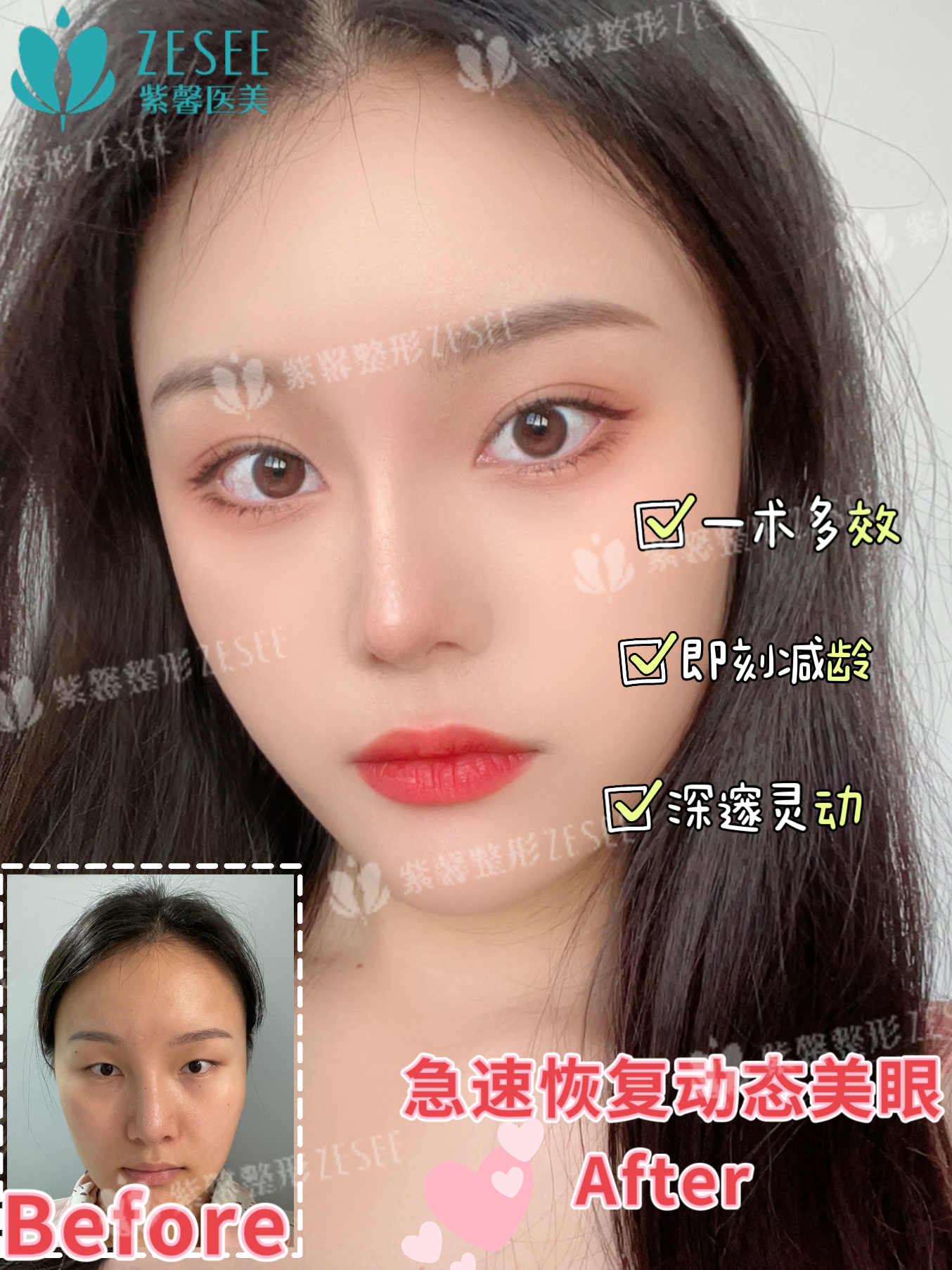 有哪些成功實例可以證明吳焱秋修復(fù)雙眼皮的實力？