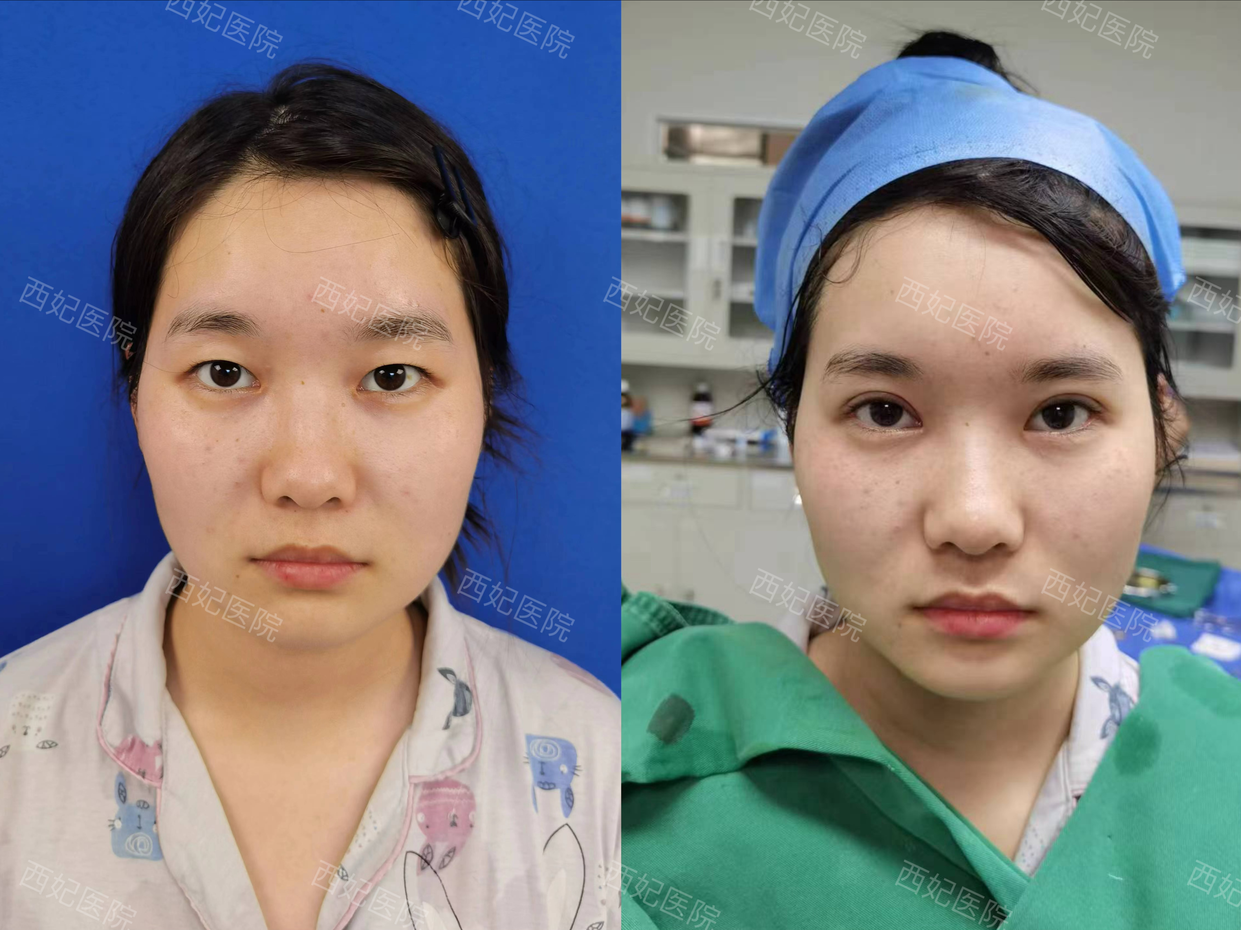 吳焱秋修復(fù)雙眼皮與其他醫(yī)生相比有哪些優(yōu)勢？