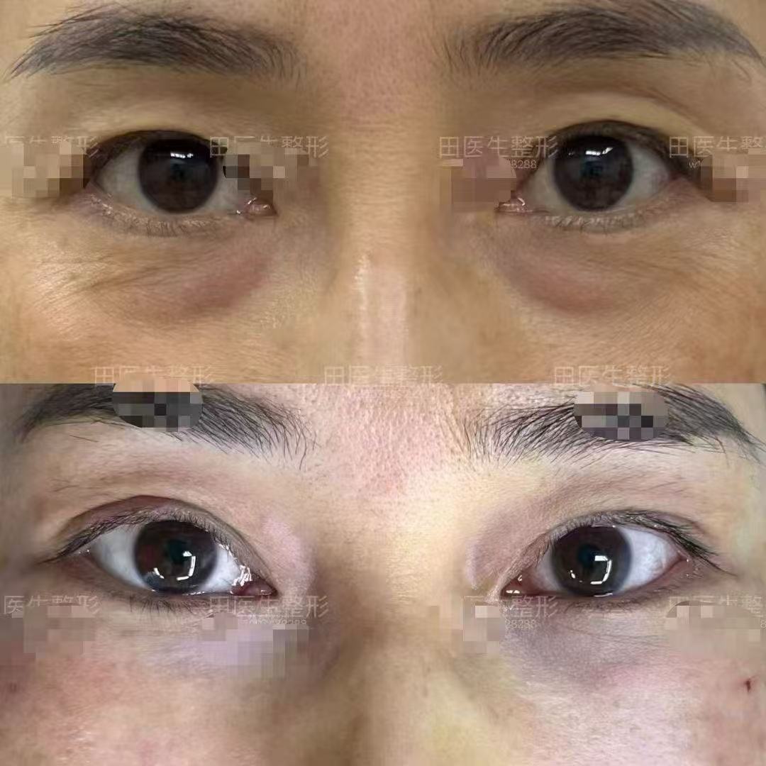 吳焱秋醫(yī)生如何打造自然靈動(dòng)美眼成效？