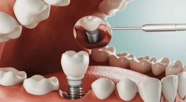 臨潁永剛口腔：能解決“疑難雜癥”的“種植牙老司機”