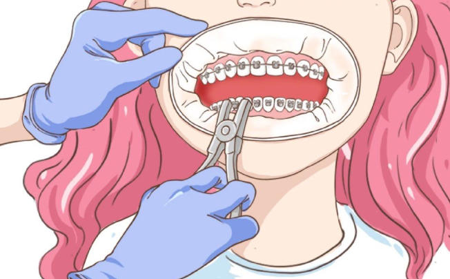 重慶齒齒美口腔牙齒矯正報價真實不套路:兒童早期矯正1580元起、隱形牙套13000元起——成功實例見證實力