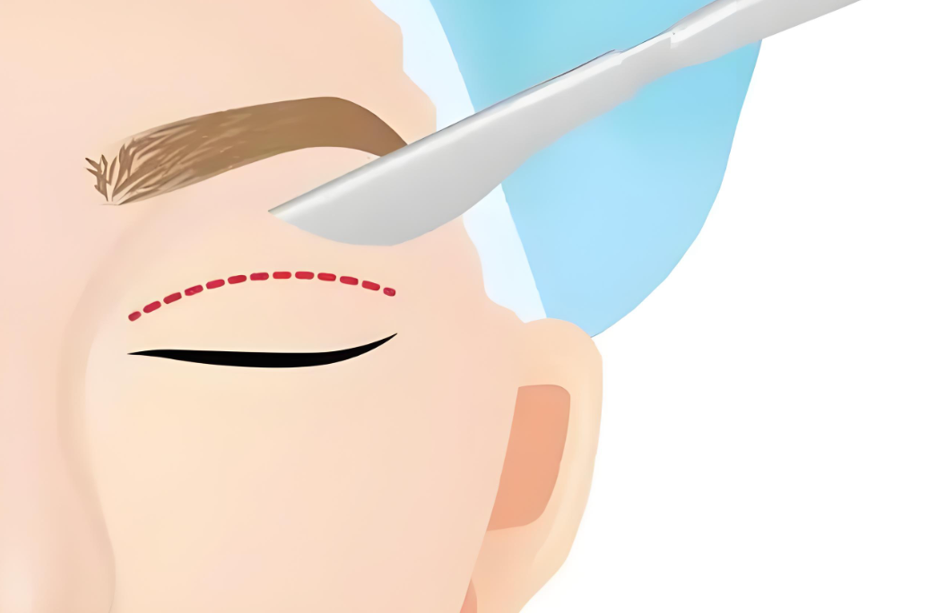 林威醫(yī)生雙眼皮技術(shù)優(yōu)勢：為什么學(xué)生黨都愛找他？