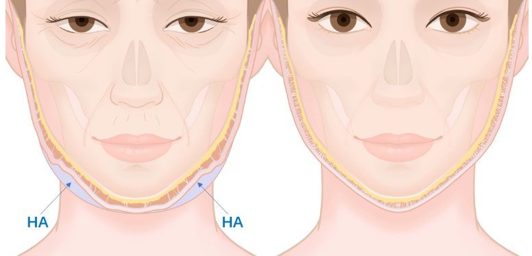 謝洋春和謝宏彬誰做拉皮好