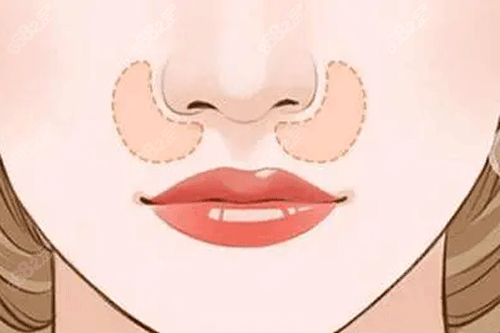 鼻基底凹陷動畫圖 鼻基底凹陷動畫圖