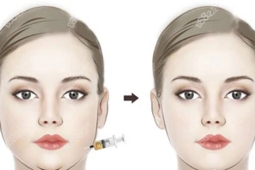 面部吸脂對(duì)比