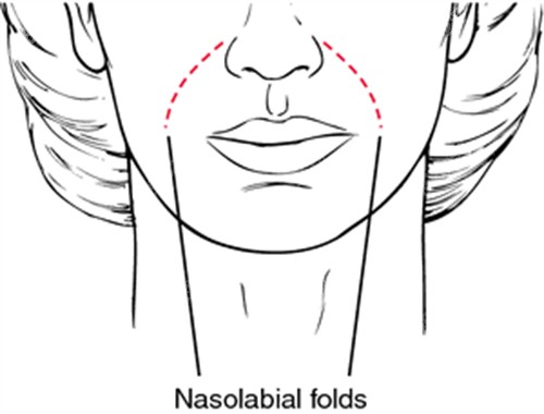 鼻基底凹陷導(dǎo)致法令紋 鼻基底凹陷導(dǎo)致法令紋
