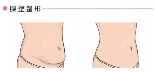 腹壁成形術(shù)前后對(duì)比圖