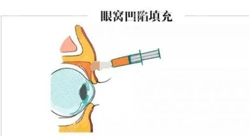 袁玉坤医生做脂肪填充怎么样？4层注射隆胸存活率很高，附多部位填充对比