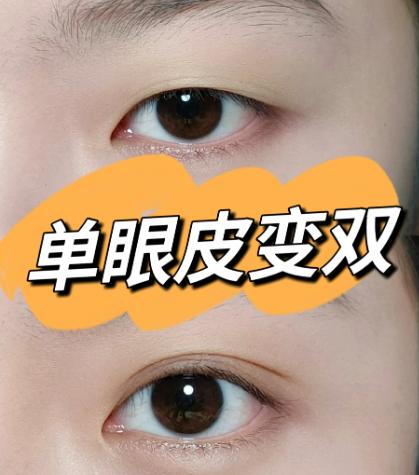 從20例臨床實例看辛容鎬雙眼皮松解的技術(shù)細節(jié)