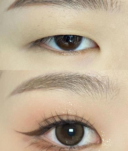 15位體驗者親述：辛容鎬雙眼皮松解的靠譜性體現(xiàn)在哪