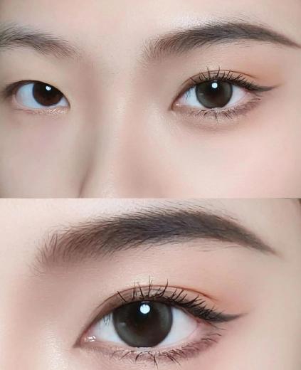 辛容鎬雙眼皮松解vs傳統(tǒng)回包內(nèi)眼角：修復(fù)差異要理清