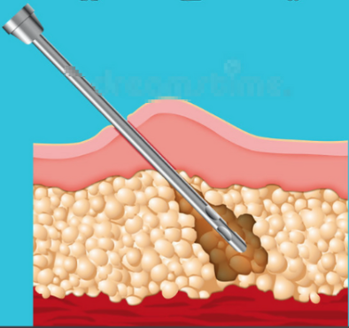 面部吸脂：手術減容“立竿見影”，但風險與變好期并存?