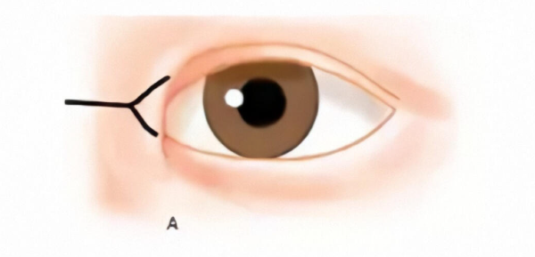 吳焱秋眼角修復(fù)手術(shù)