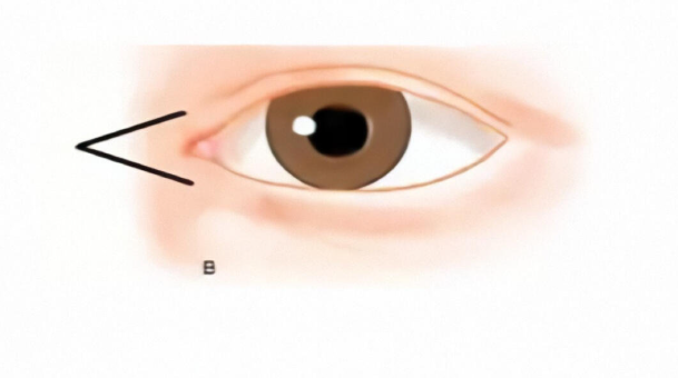 王恒醫(yī)生眼角修復(fù)手術(shù)