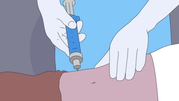 漫一凡腰腹吸脂價格