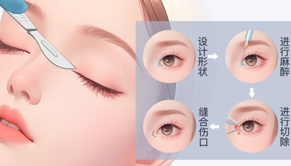 吳焱秋醫(yī)生眼修復技術(shù)特色