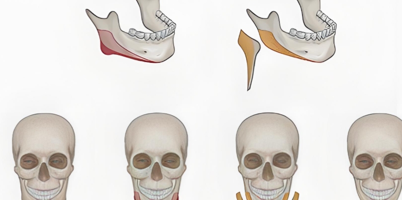 李運峰磨骨預約