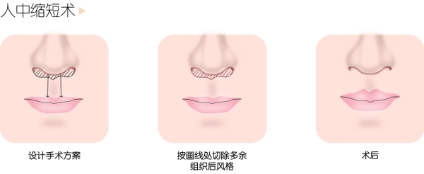 李澤人中窩加深手術(shù)