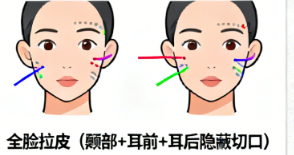 高亞東拉皮手術(shù)價(jià)格