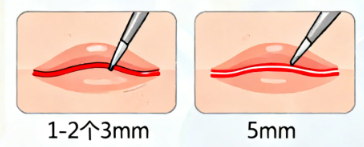 黃金束帶緊縮手術