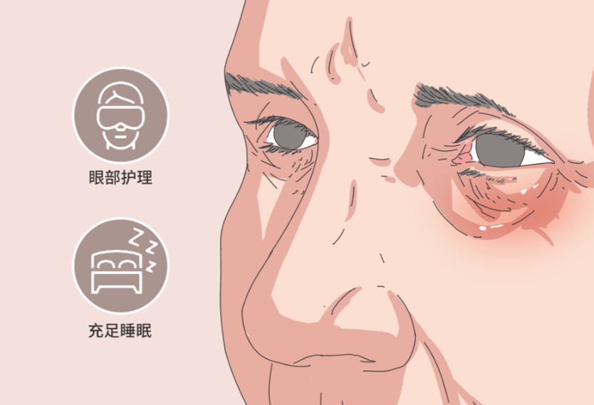 成都楊迪眼周筋膜提升手術(shù)費(fèi)用