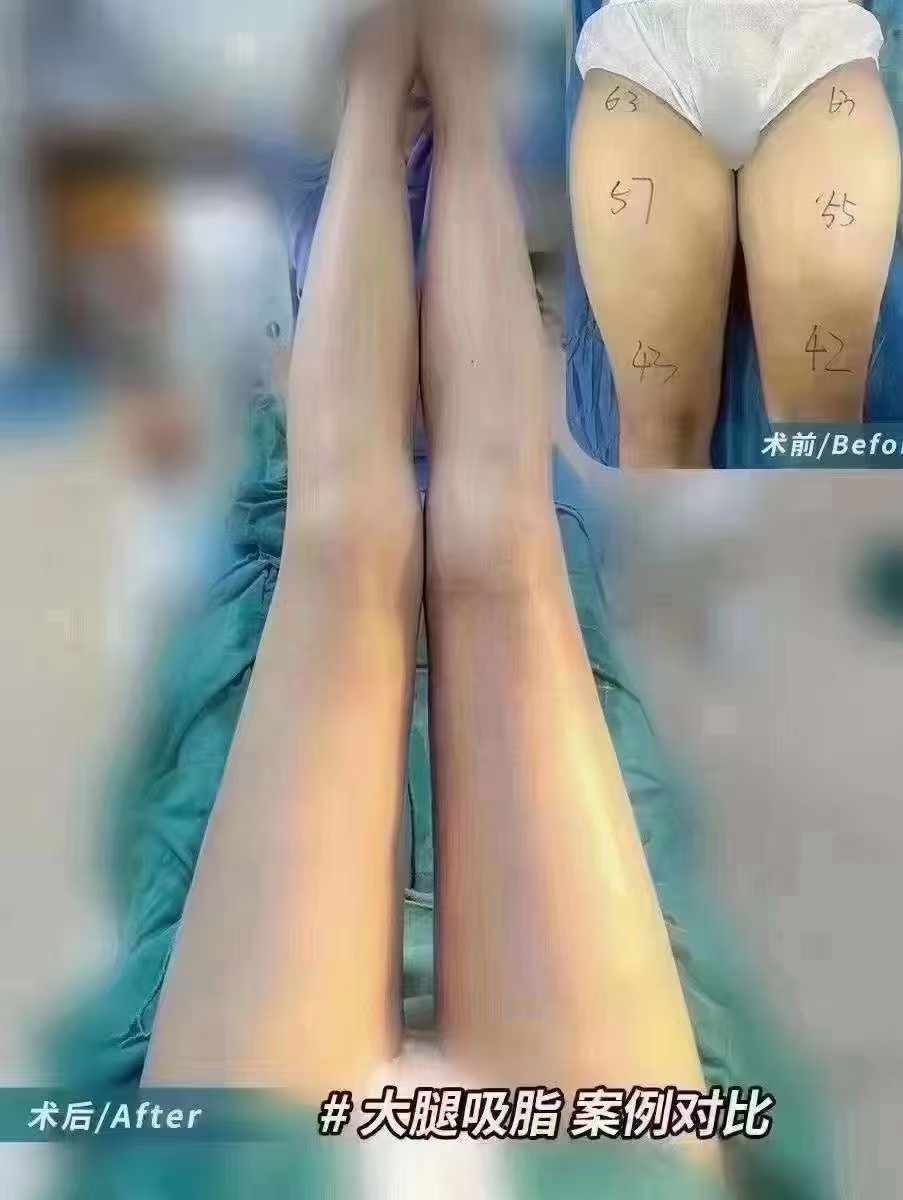 二、王棚醫(yī)生：經(jīng)驗(yàn)多的吸脂“老將”