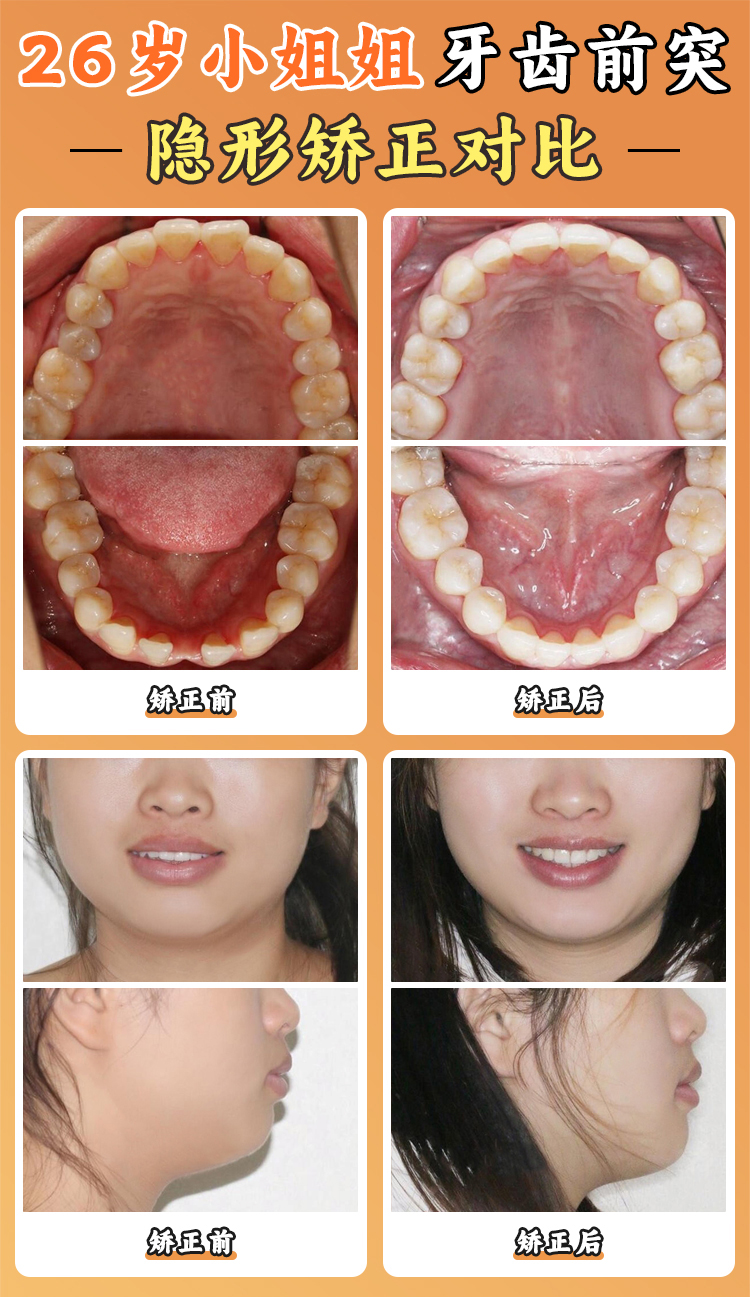 寧鄉(xiāng)天天牙科醫(yī)院隱形牙套的價(jià)格是多少？最新價(jià)格表出爐：國(guó)產(chǎn)1.8萬(wàn)起/進(jìn)口2.1萬(wàn)起超詳細(xì)