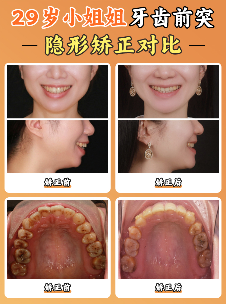 寧鄉(xiāng)天天牙科醫(yī)院隱形牙套價(jià)格的影響因素