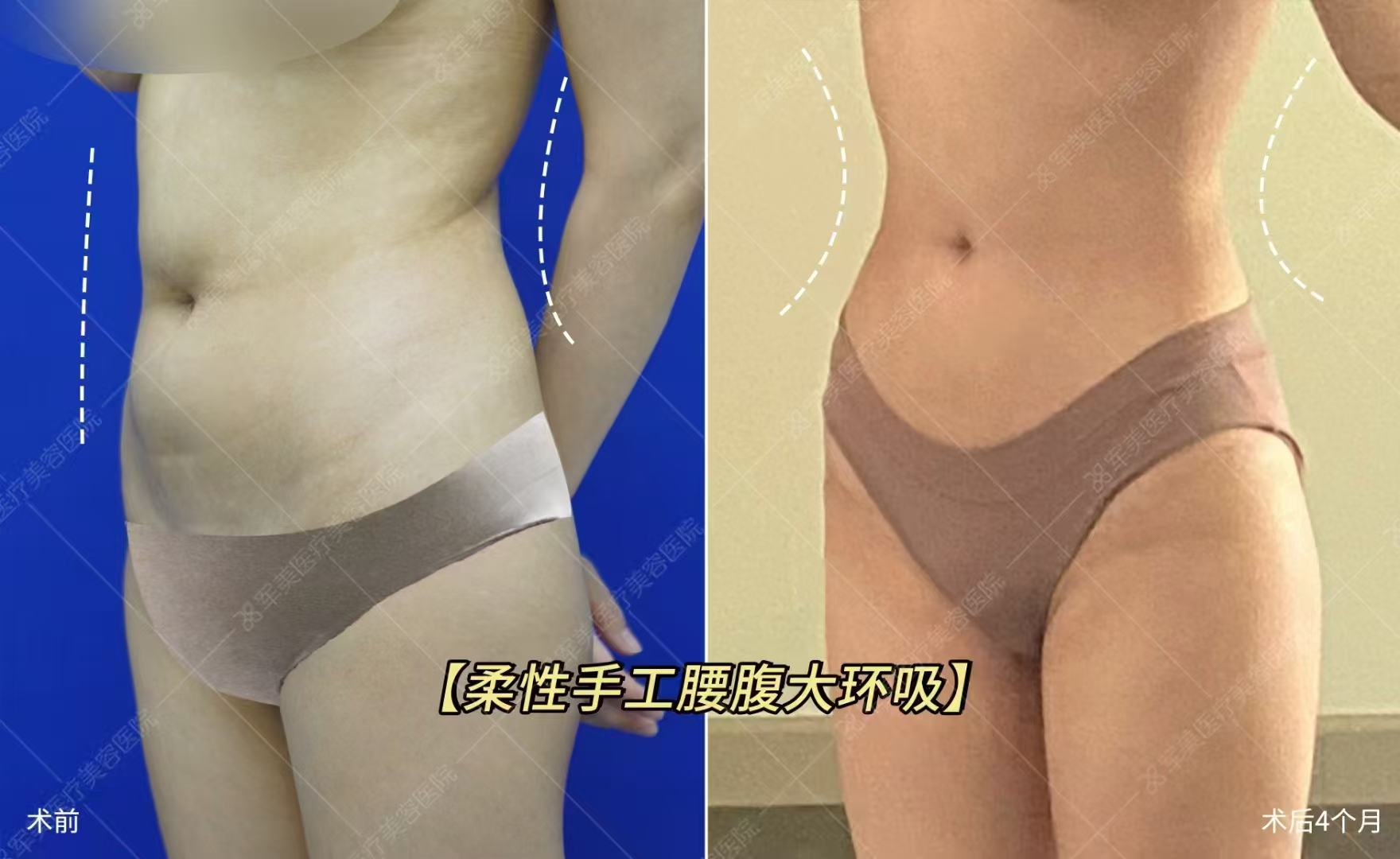 廣州廣大醫(yī)院吳訓(xùn)醫(yī)生凸嘴手術(shù)超厲害——吳訓(xùn)醫(yī)生實力大起底