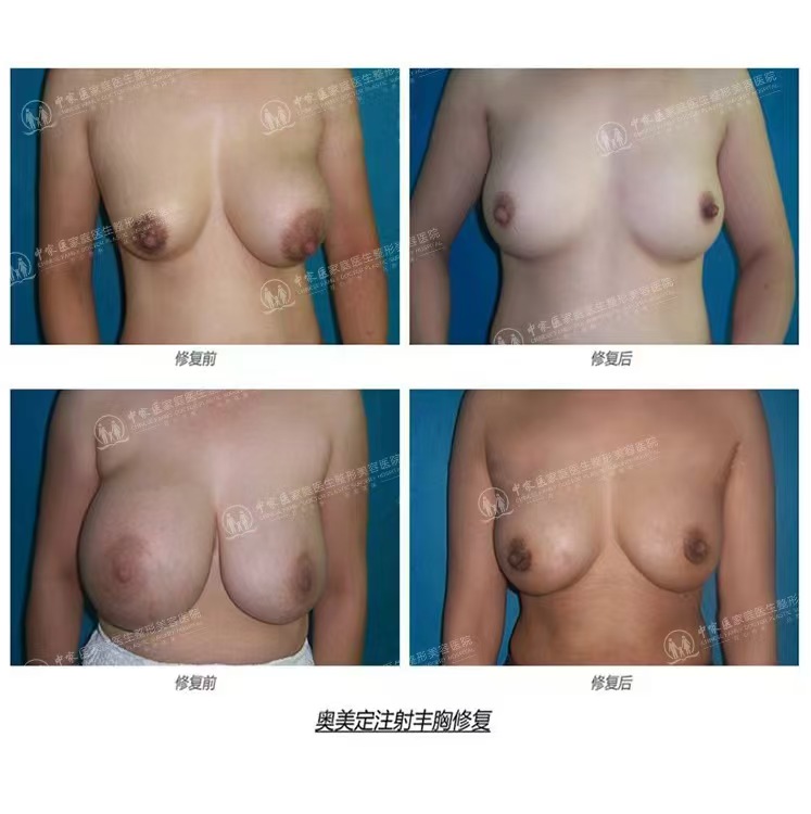 廣州廣大醫(yī)院吳訓(xùn)醫(yī)生凸嘴手術(shù)超厲害——廣州廣大醫(yī)院正頜手術(shù)價格分析