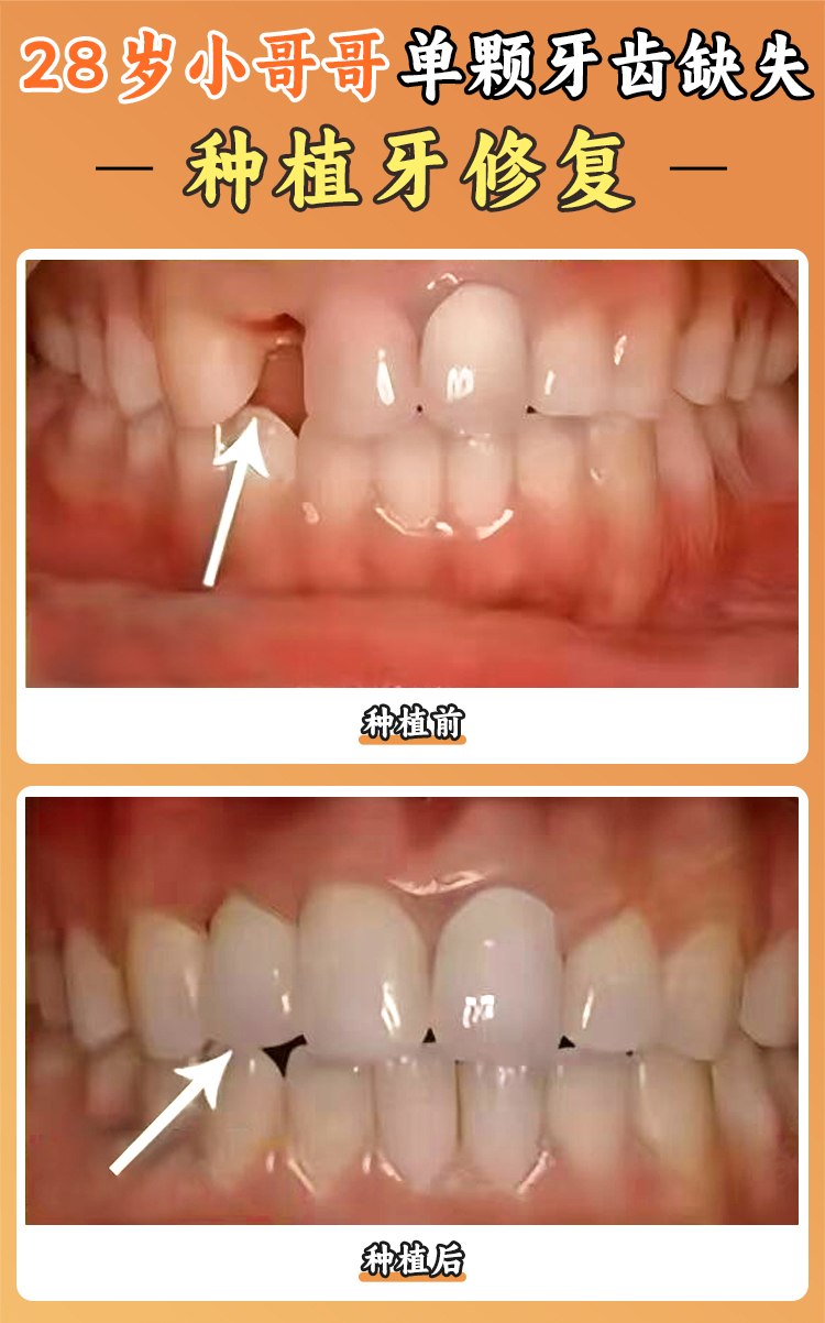 江門簡牙口腔醫(yī)院有正規(guī)種植牙資質(zhì)嗎？