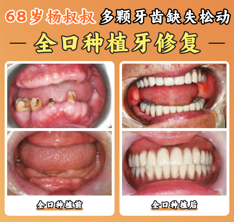 江門簡牙口腔醫(yī)院的種植牙醫(yī)生技術(shù)好嗎？