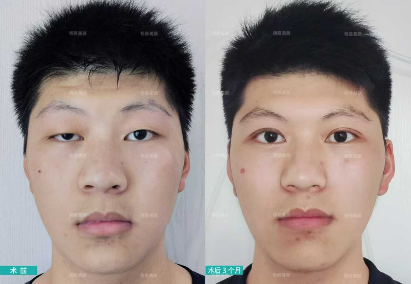 新美顏醫(yī)療美容門診部：超20年經(jīng)驗(yàn)院長塑造自然幼態(tài)臉