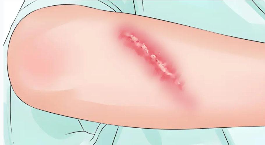 三、于艷菊醫(yī)生治療不同類型疤痕的方案