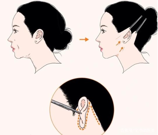 穆寶安v美減齡和大拉區(qū)別