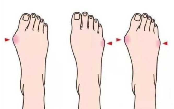 圣嘉新蘇敬達(dá)醫(yī)生大腳骨矯正口碑