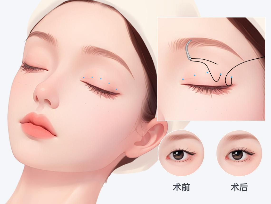 于曉雪雙眼皮過度營銷技術(shù)差是謠言