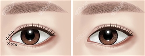 開眼角手術(shù)前后對(duì)比圖