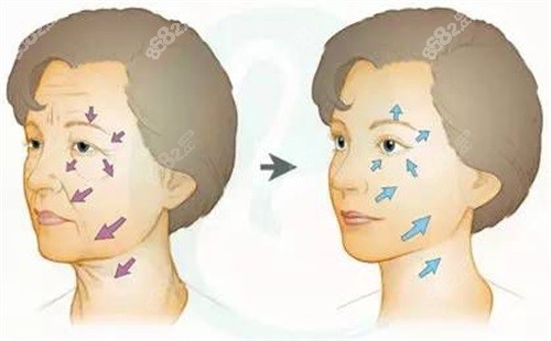 面部除皺對(duì)比圖