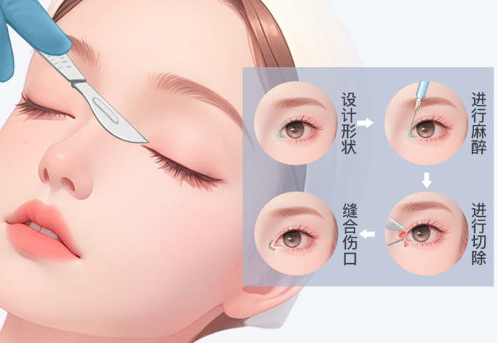鄭州楊曉紅眼修復(fù)的手術(shù)特點