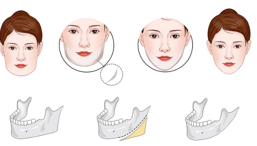 張笑天磨骨的核心優(yōu)勢