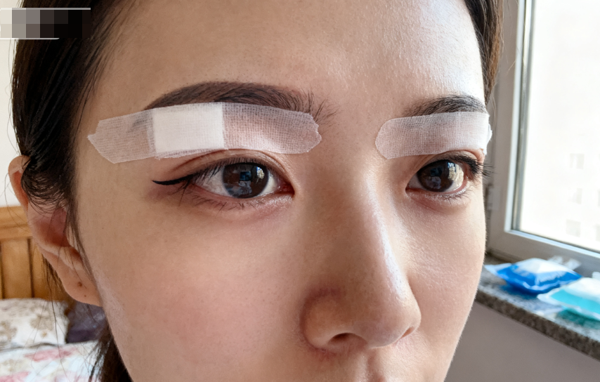 網(wǎng)友反饋杜園園和張冰潔修復(fù)眼袋與選擇建議